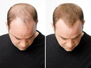  effect before and after follixin application