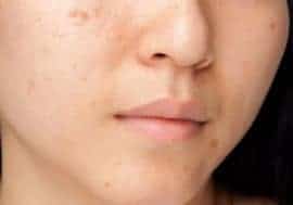  acne on face
