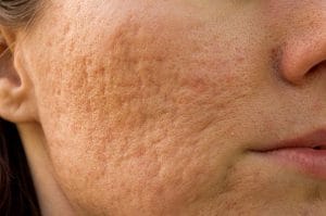 Alantan - will it remove acne scars and blemishes? 2 acne-prone skin