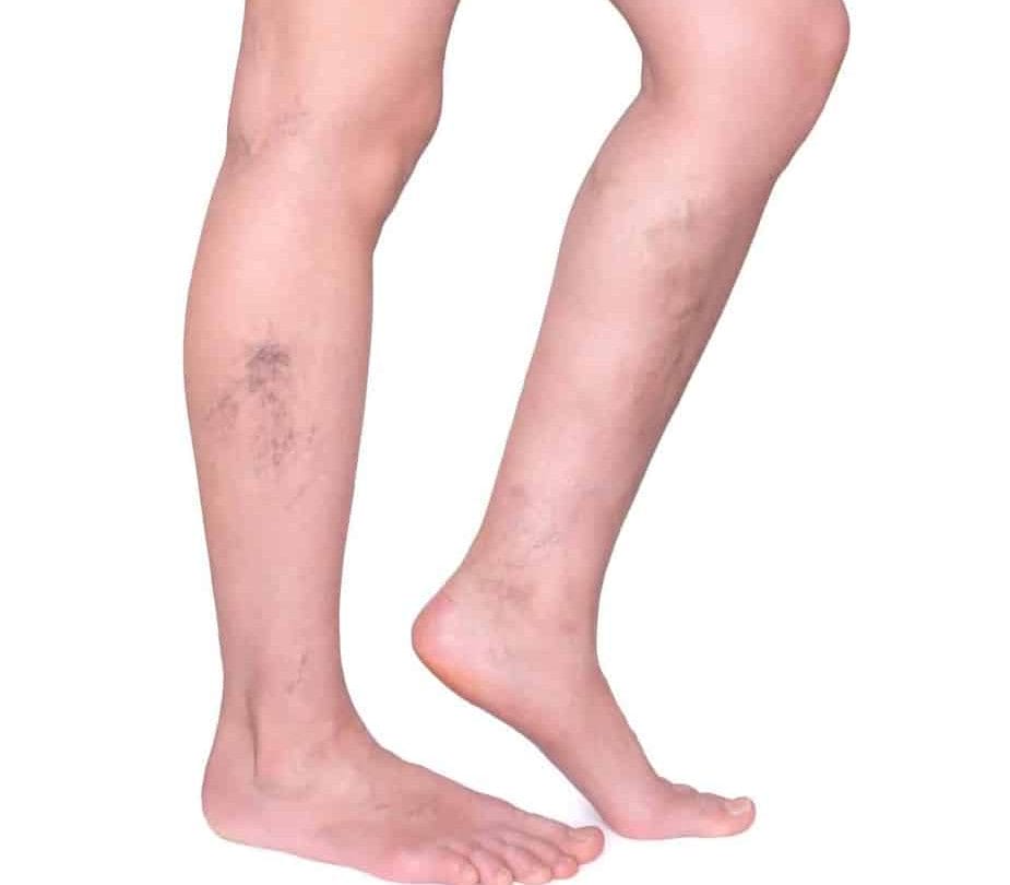 Varicose veins of lower limbs - what is it, how to prevent? Varicose veins diet 1 754da71f 801a 4b8a 9ac0 417cad63e885