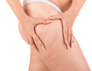 Perfect Body Cellulite - tackles even the biggest cellulite 2 cellulite on thighs