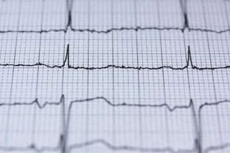 Cardio NRJ - keep your hypertension under control 2 electrocardiogram printout