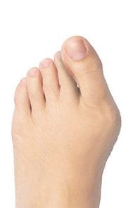 Kyöko Uno - a device that removes bunions in 30 days 2 bunions