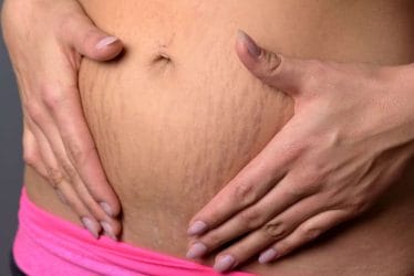 Revamin Stretch Mark - composition, effects and opinions about stretch mark removal cream 2 Stretch marks on the stomach