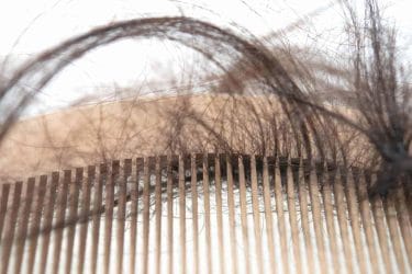 Telogenetic alopecia - causes and symptoms. 2 hair loss