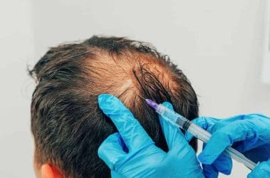  mesotherapy of the scalp