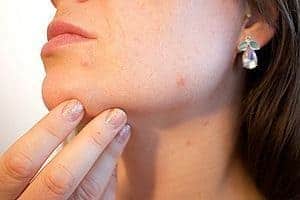  woman with acne-prone skin