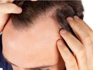 Alpecin Shampoo - opinions, effects it gives 2 a man with hair curves
