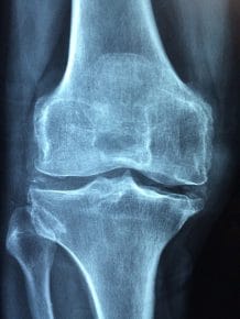 Hondrowell - once and for all it will deal with even the most severe joint pain 2 Knee X-ray