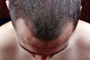 Ketokonazol - opinion on effectiveness in combating baldness 2 hair with dandruff