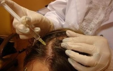 Telogenetic alopecia - causes and symptoms. 4 mesotherapy