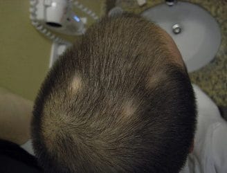 Alopecia areata - causes, symptoms and treatment 2 alopecia areata