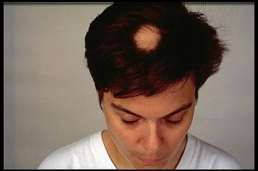 Alopecia areata - causes, symptoms and treatment 3 alopecia areata
