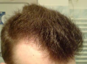 Skin diseases - of which hair loss is a symptom. 2 A Man with Circles