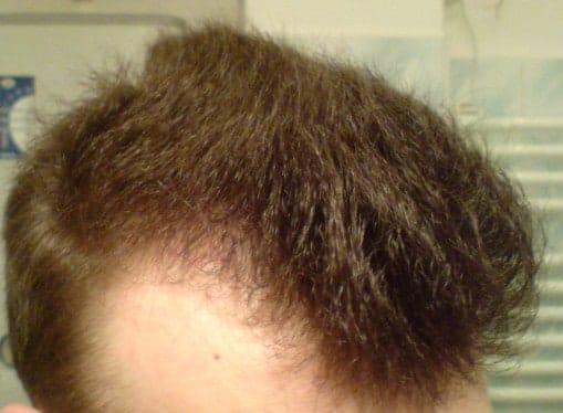 Skin diseases - of which hair loss is a symptom. 1 zakola12