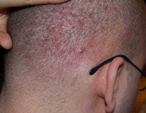  acne of the scalp