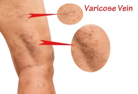 Horse chestnut extract or hesperidin - which works better for varicose veins 2 varicose vein