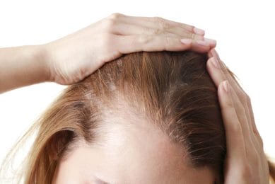 Androgenetic alopecia - what it is and how to treat it effectively. 3 female pattern baldness