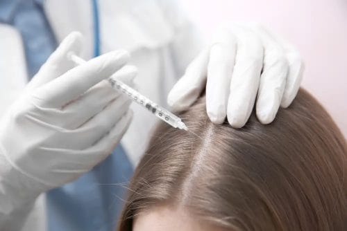Mesotherapy of hair - opinions, effects and procedure course 3 needle mesotherapy of the scalp