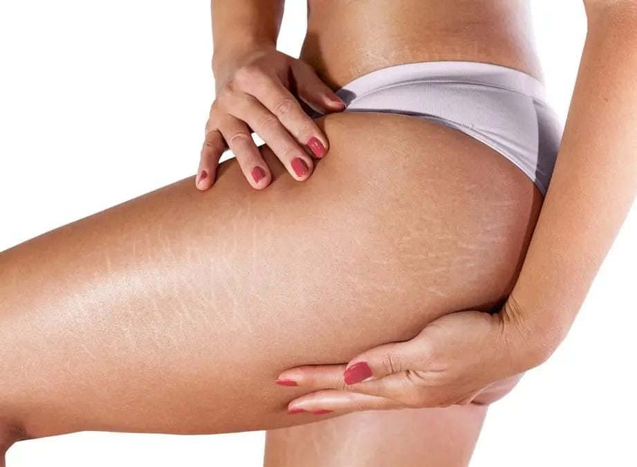How to get rid of stretch marks - a small compendium of effective methods 1 stretchmark