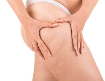 Cellulit - causes and methods of fighting. How to get rid of unsightly orange peel? 4 Cellulite