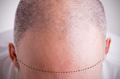  male androgenic alopecia