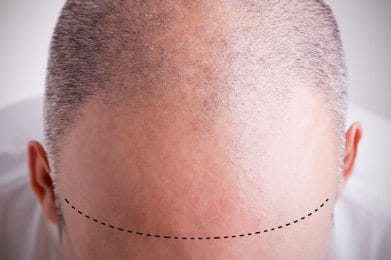 Androgenetic alopecia - what it is and how to treat it effectively. 2 male androgenic alopecia