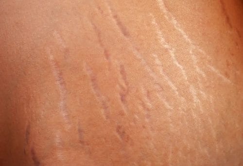  Skin with stretch marks
