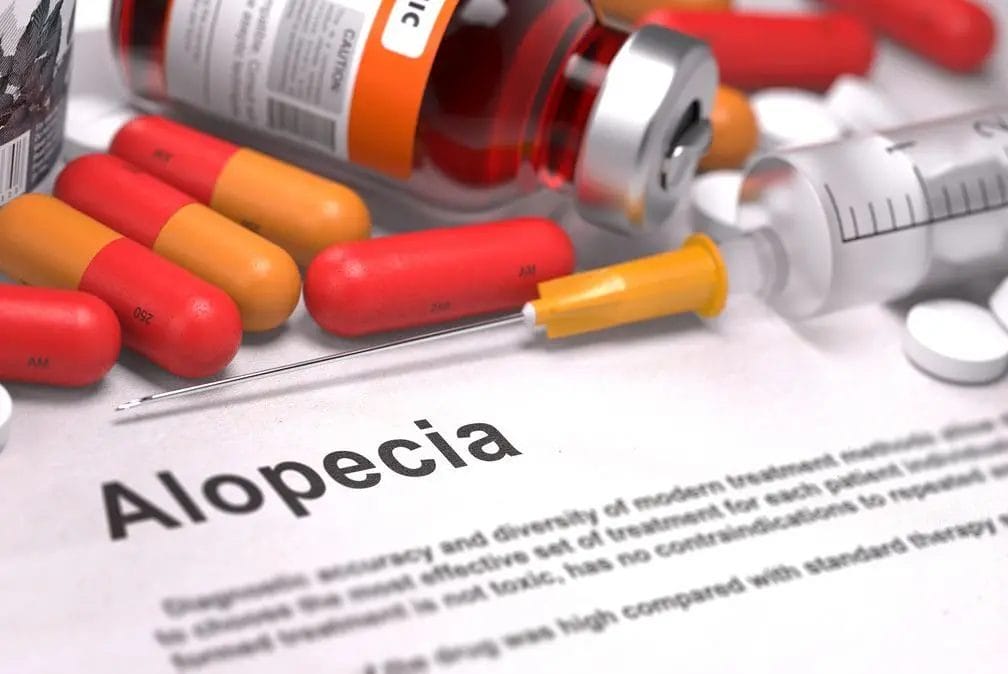Minoksydyl or finasteride - pharmacological treatment of alopecia. 1 alopecia