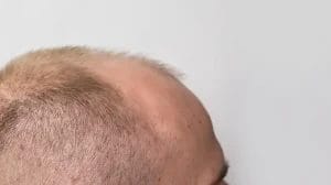 alopecia