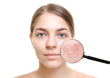  woman with acne