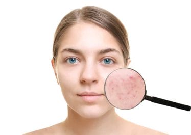 Revamin Acne Cream - cream that removes acne and other skin imperfections 2 woman with acne