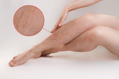  varicose veins of the lower extremities