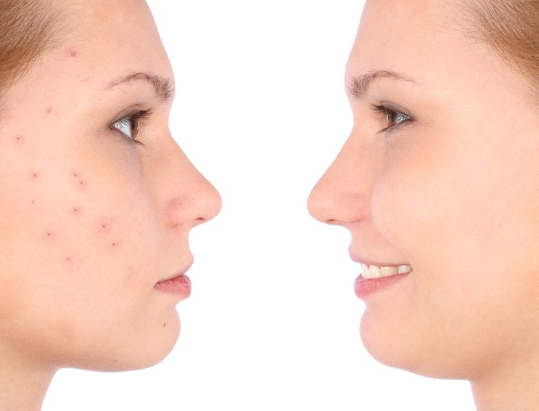  woman with and without acne